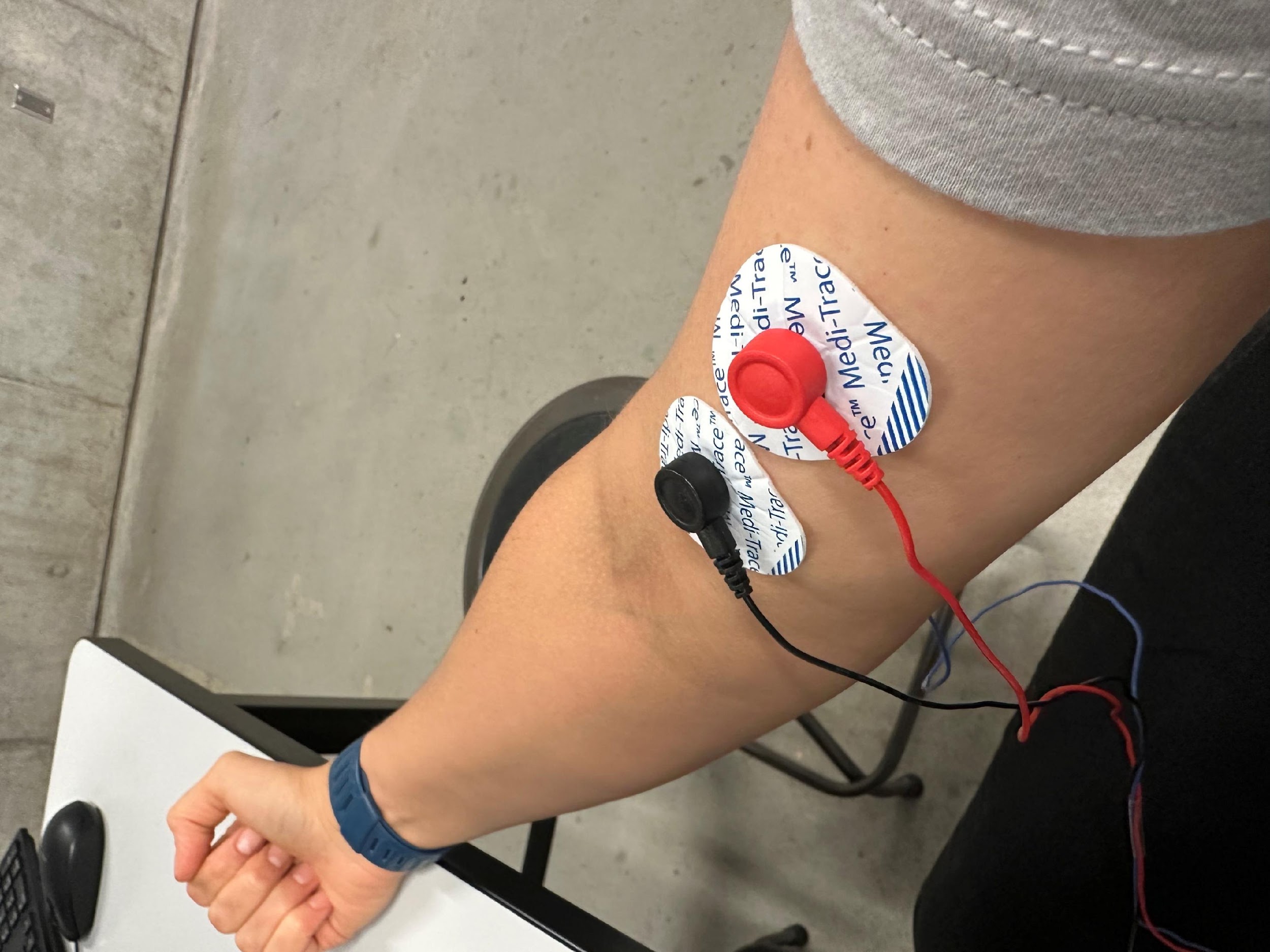 EMG electrode pad placement alternate view